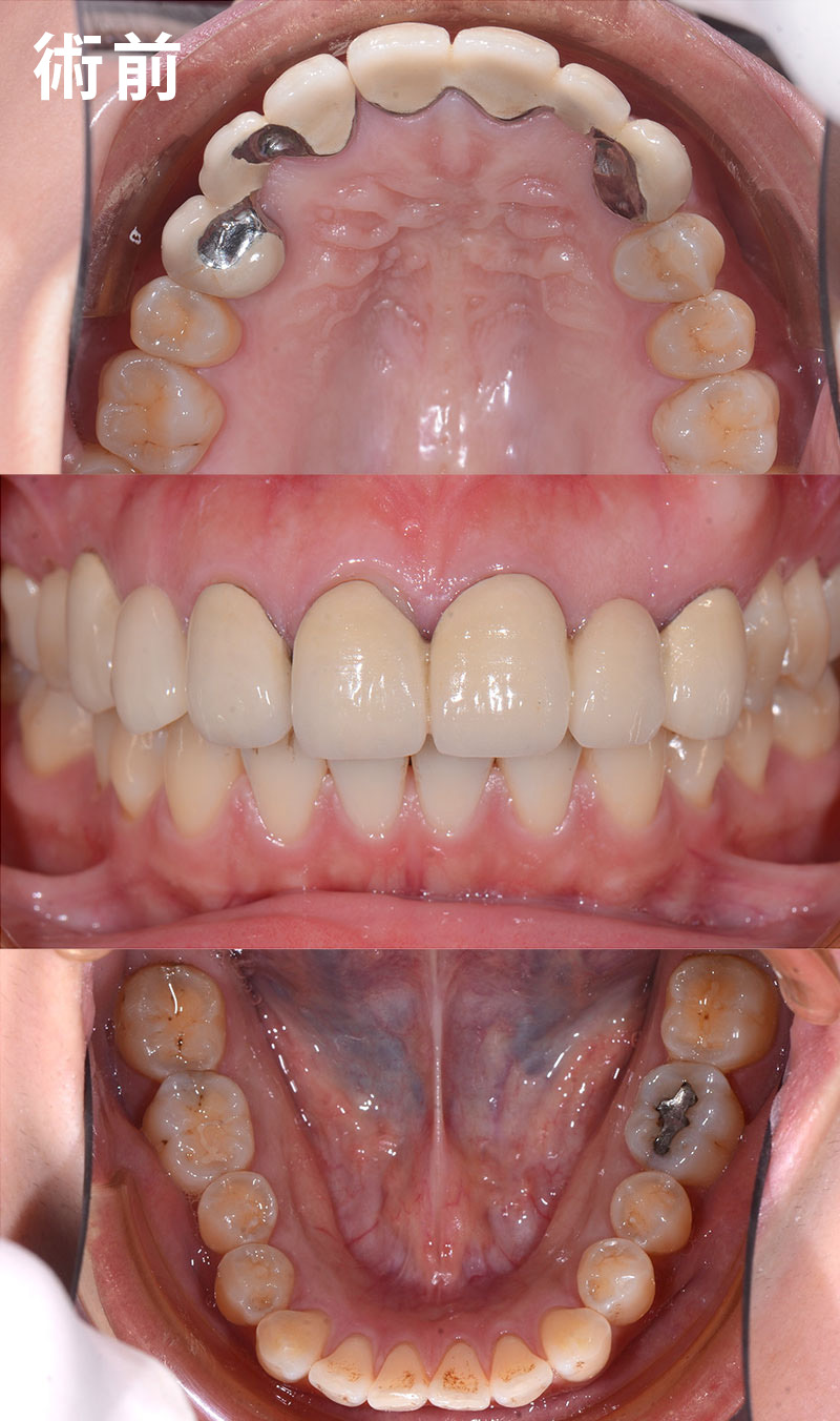 假牙拆除後，重新植牙術前案例照