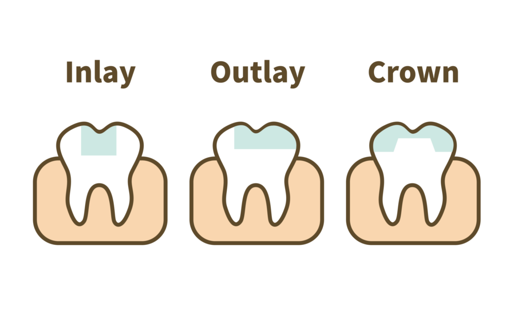 假牙 31 Inlay、Outlay、Crown