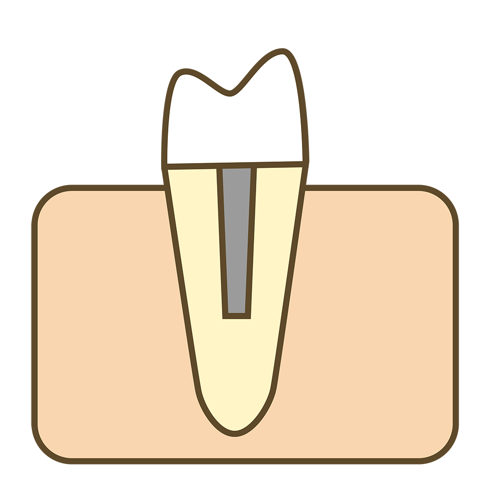 六 根管治療假牙