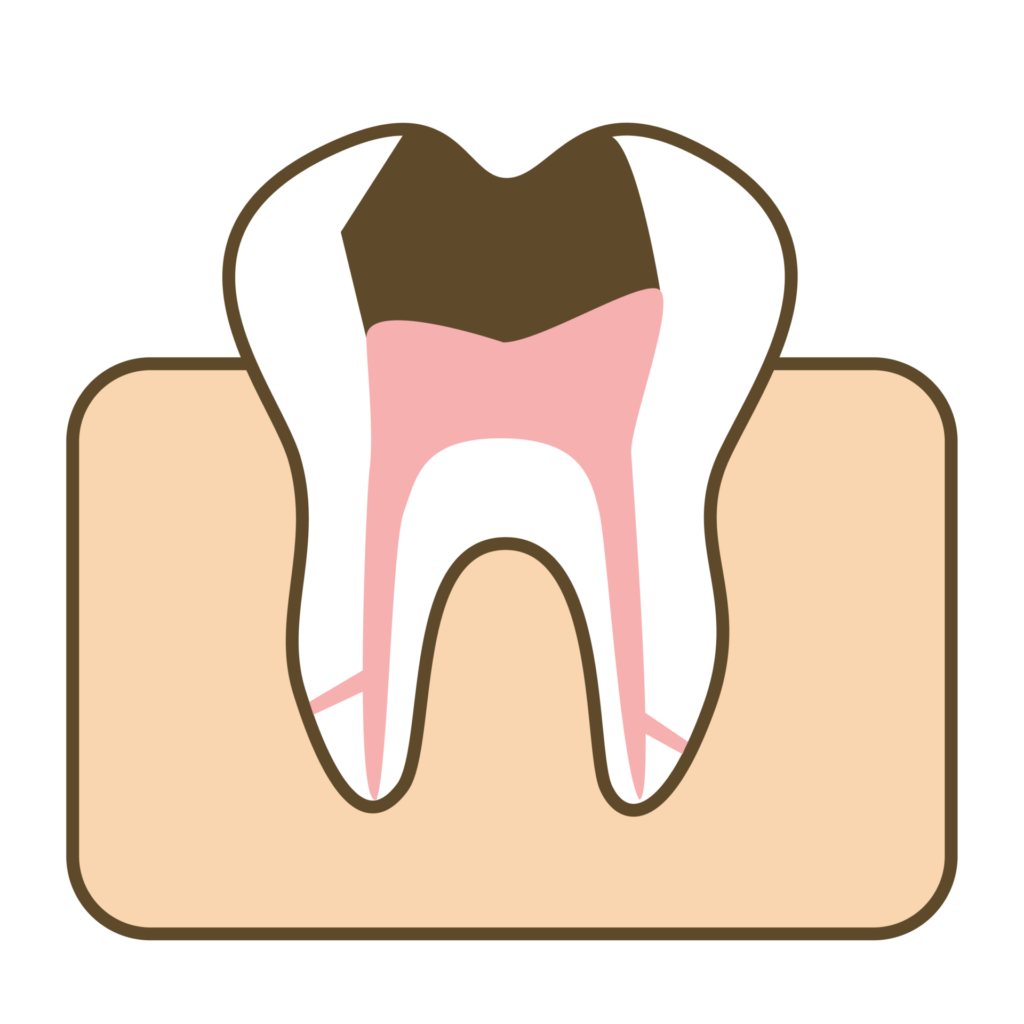 根管治療 24 牙髓炎